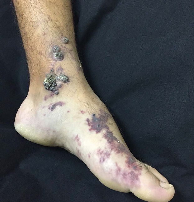 Placas vinhosas elevadas, cerat&oacute;sicas e fri&aacute;veis