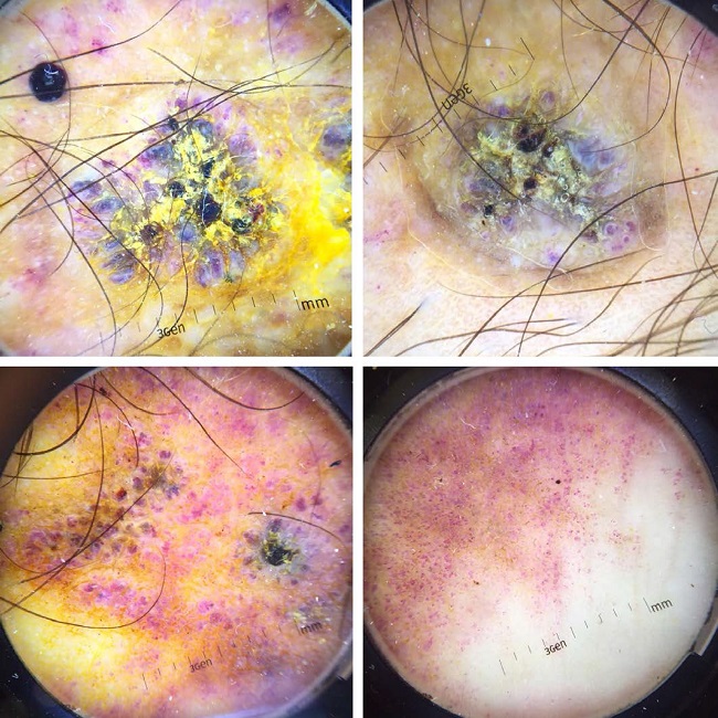 Dermatoscopia evidencia ceratose, com discreto v&eacute;u esbranqui&ccedil;ado, entremeando lagos vasculares vinhosos/enegrecidos, com pequenas crostas hemorr&aacute;gicas e eritema perif&eacute;rico