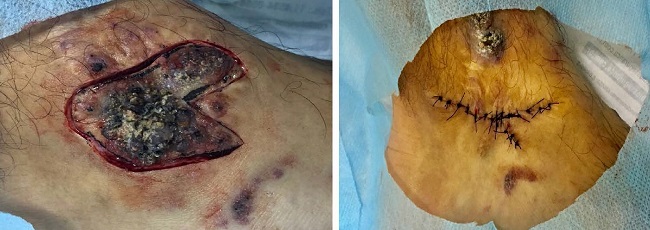 Excis&atilde;o cir&uacute;rgica profunda