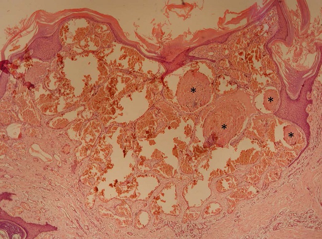 Ectasia e prolifera&ccedil;&atilde;o de vasos na derme superficial e m&eacute;dia, circundada por epit&eacute;lio escamoso epid&eacute;rmico hiperpl&aacute;sico, sem atipias (Hematoxilina & eosina 40x)