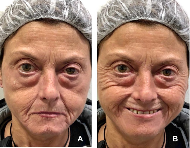 Exame f&iacute;sico da paciente: (A) Em repouso. (B) Em din&acirc;mica