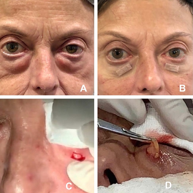 Pr&eacute; e p&oacute;s-operat&oacute;rio imediato, incis&atilde;o cut&acirc;nea e visualiza&ccedil;&atilde;o da
                            gordura infraorbit&aacute;ria