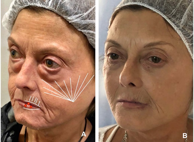 &Aacute;reas tratadas com &aacute;cido hialur&ocirc;nico