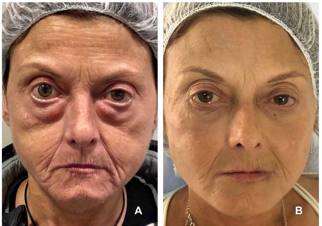 &Aacute;reas tratadas com &aacute;cido hialur&ocirc;nico. Antes e depois