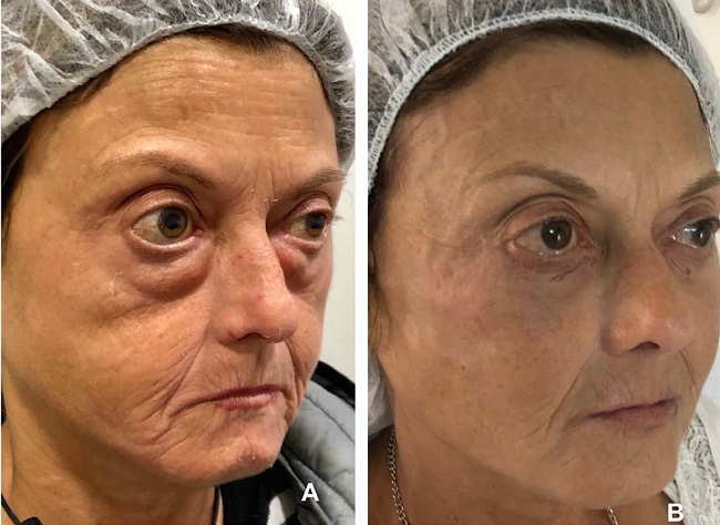 Pr&eacute; e p&oacute;s de obl&iacute;quo