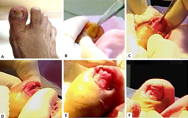 Unha em pin&ccedil;a no ded&atilde;o do p&eacute; direito do paciente (A). Avuls&atilde;o total das unhas (B). Incis&atilde;o em T invertido partindo da parte medial do leito ungueal medial e se estendendo at&eacute; o hipon&iacute;quio (C). Explora&ccedil;&atilde;o da falange dorsal (D). Remo&ccedil;&atilde;o de oste&oacute;fitos na falange dorsal (E). Sutura na parte medial do leito ungueal ap&oacute;s remo&ccedil;&atilde;o dos oste&oacute;fitos (F). Sutura dos dois lados do leito ungueal nas bordas laterais (G)