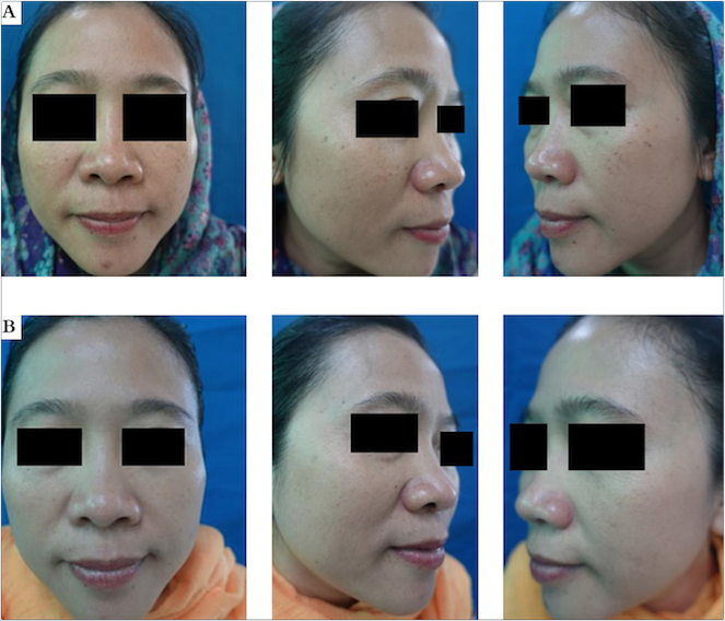 A - Foto clínica do participante antes da terapia, melasma apareceu em ambas as bochechas; B - Fotos clínicas dos participantes nas semanas 4, 8 e 12 após a primeira terapia a laser e creme AT 4% duas vezes ao dia. Houve melhora do melasma em ambas as bochechas.