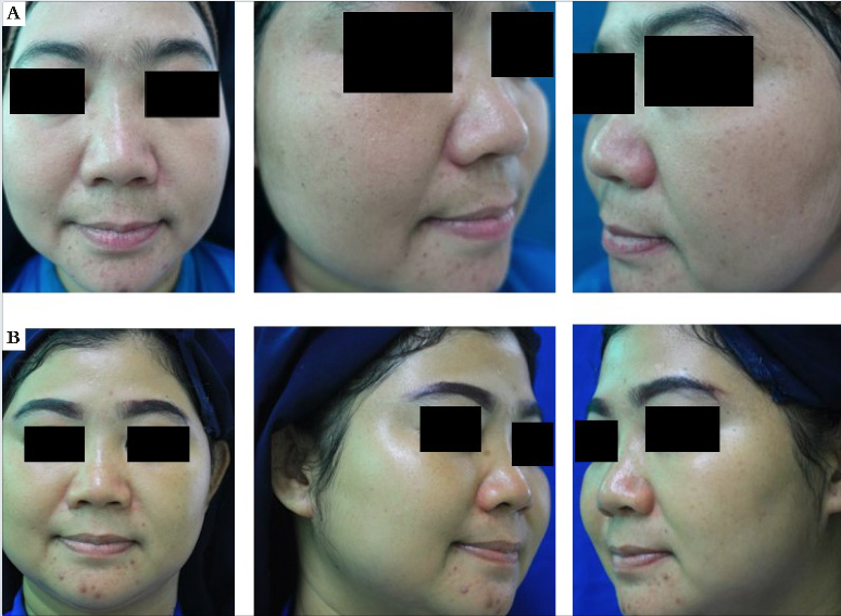 Número de pacientes nos grupos tratamento e controle durante a pesquisa