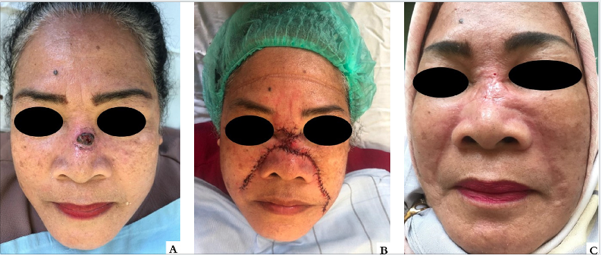 Retalhos de avan&ccedil;o bilateral na subunidade nasal. A - Fotografia pr&eacute;-operat&oacute;ria B - P&oacute;s-operat&oacute;rio imediato C - Resultado tardio.