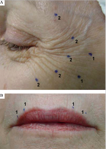 Doses (U) e pontos de aplicação da toxina onabotulínica, na concentração de 100U/mL. A – região periorbitária; B – região perioral