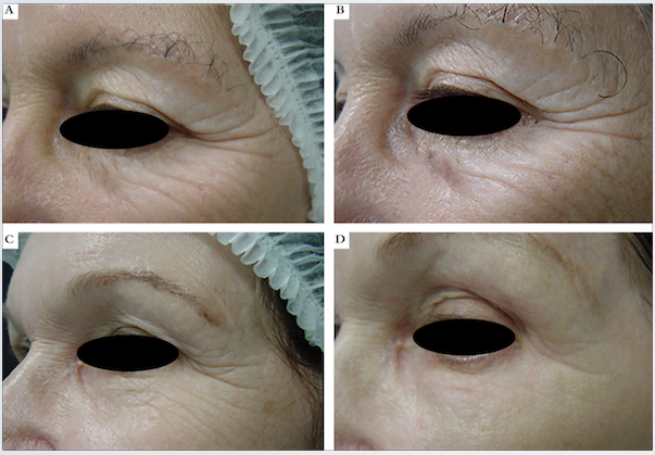 Resultado clínico antes e 45 dias depois da aplicação de peeling de fenol 88% na região periorbitária. A e B – somente fenol; C e D – toxina botulínica e peeling de fenol