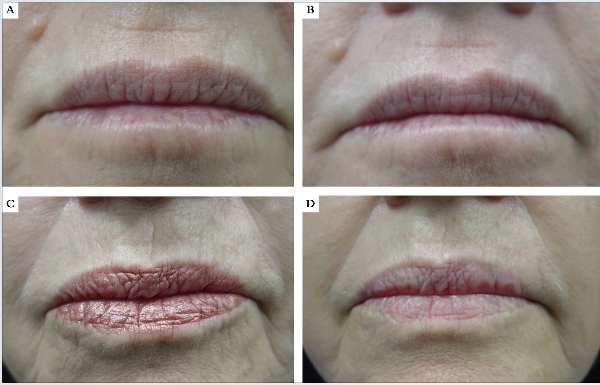 Resultado clínico antes e 45 dias depois da aplicação de peeling de fenol 88% na região perioral, em repouso. A e B – somente fenol; C e D – toxina botulínica e peeling de fenol