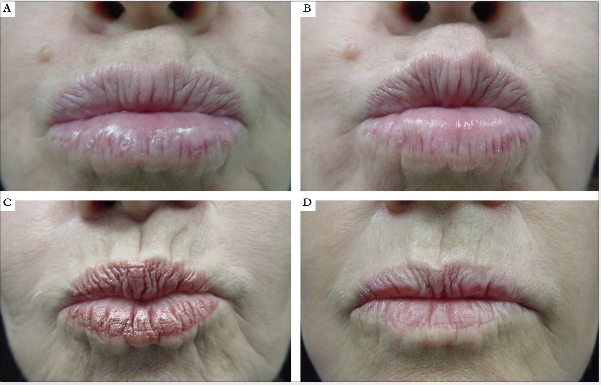 Resultado clínico antes e 45 dias depois da aplicação de peeling de fenol 88% na região perioral, contraindo. A e B – somente fenol; C e D – toxina botulínica e peeling de fenol