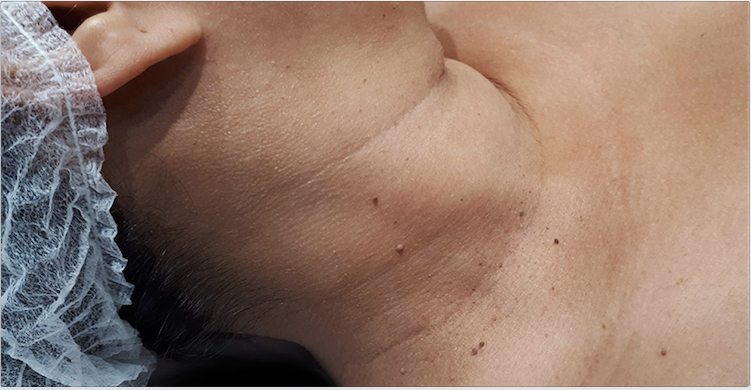 Acrocórdons na região cervical de uma participante do sexo feminino