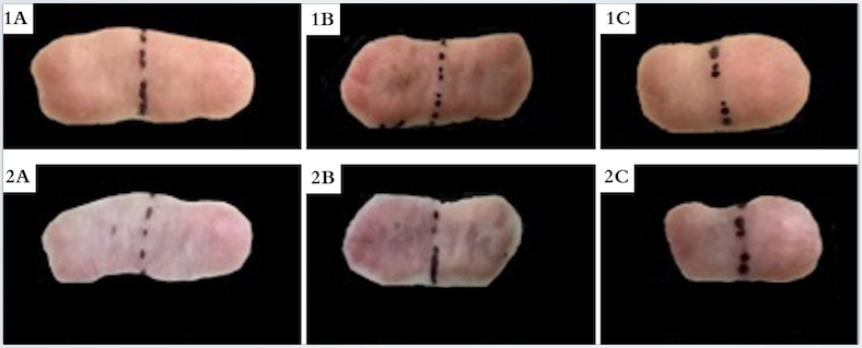 Pareamento de três queloides: Letra A - corresponde à fase anterior ao início do tratamento e a B, a um mês após o final da 3ª sessão. A porção mediana da lesão foi demarcada para limitar os lados esquerdo e direito. Esquerdo: infiltração intralesional de corticoide. Direito: laser fracionado ablativo com drug delivery de corticoide