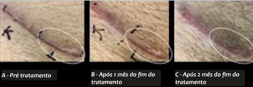 Análise clínica pré e pós-tratamento do queloide pela escala de Vancouver adaptada para cada uma das terapêuticas propostas e avaliação da redução do tamanho da lesão em centímetros e do impacto na qualidade de vida do paciente antes e após o tratamento
