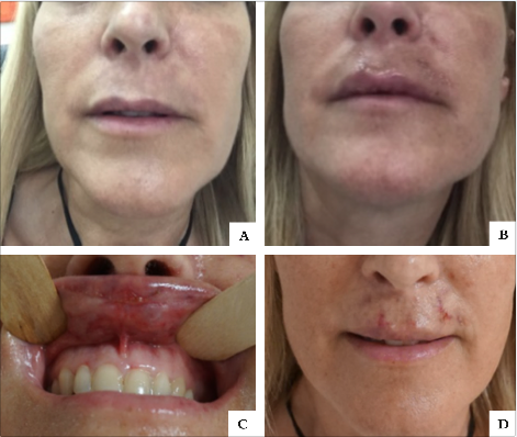 Case 3 (A). Skin discoloration (1 day postinjection) (B). Pustular eruption in the upper lip and left lower nasolabial areas (5 days post-injection) (C). Erosions on the mucosal side of the upper left lip (5 days post-injection) (D). Resolution with residual crusting