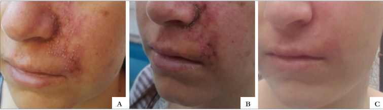 A - Descoloração da pele (1 dia após a injeção) B - Erupção pustular no lábio superior e na região nasolabial inferior esquerda (5 dias pós-injeção) C - Erosões na mucosa ao lado do lábio superior esquerdo (5 dias pós-injeção) D - Resolução com crosta residual