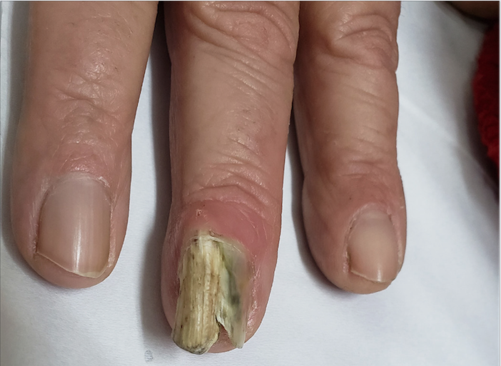 Espessamento da placa ungueal, hipercurvatura transversa, xantoníquia