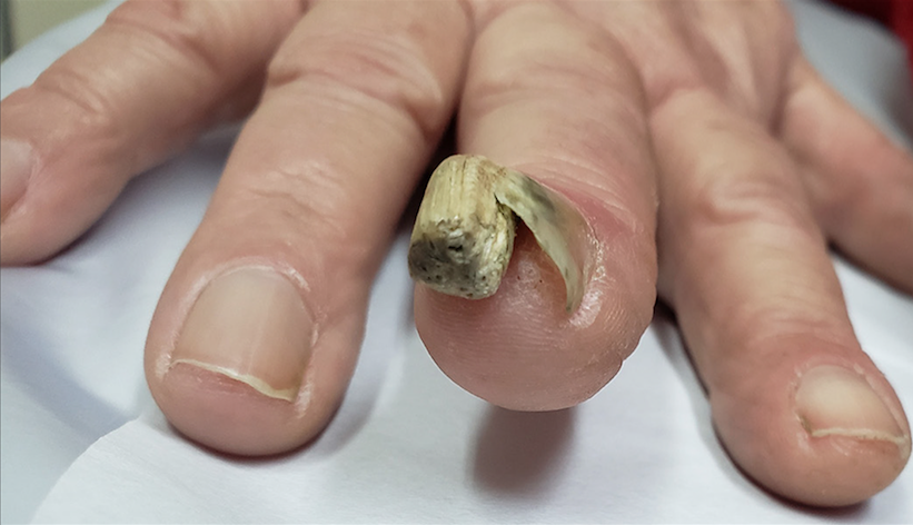 Espessamento da placa ungueal, hipercurvatura transversa e pequenos orifícios na borda livre da unha