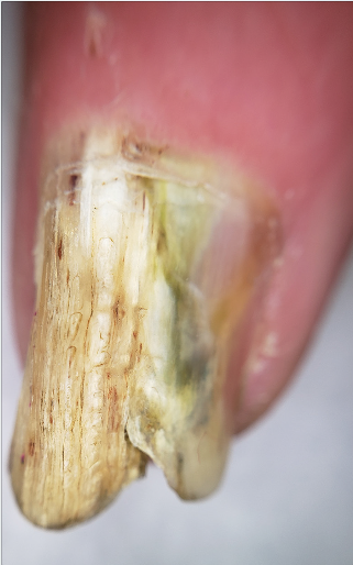 À dermatoscopia, estilhas hemorrágicas