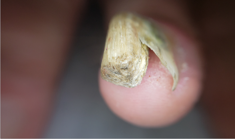 Dermatoscopia da borda livre da unha: perfurações