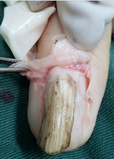 Transoperatório: rebatimento da dobra ungueal proximal, expondo o tumor