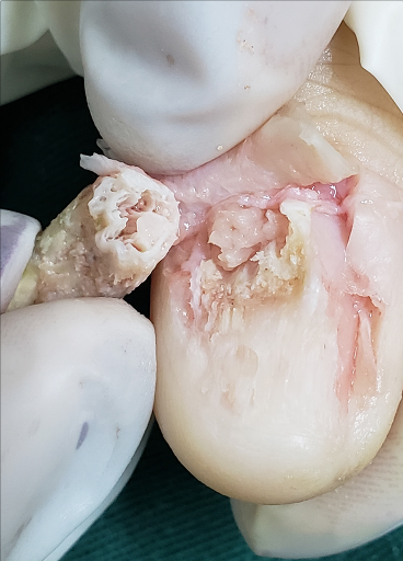 Transoperatório: projeções digitiformes