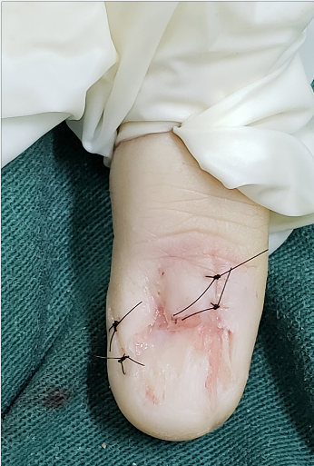 Fechamento primário