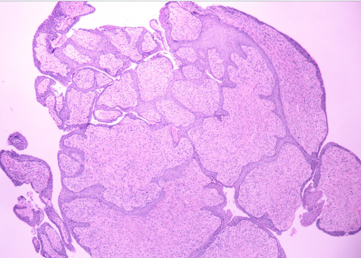 A histologia demonstrou hiperplasia digitiforme revestida por epitélio escamoso, formando projeções (Hematoxilina & eosina, 4x)