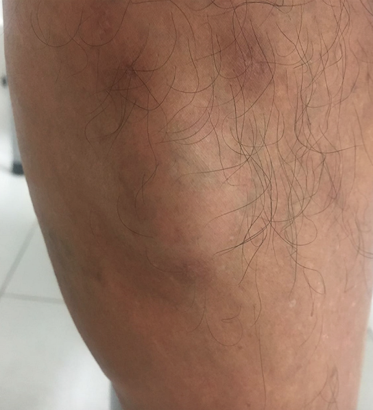 Nódulo subcutâneo (4cm de diâmetro), recoberto por pele normal, com consistência amolecida, não aderido aos planos profundos, indolor à palpação, sem orifício central