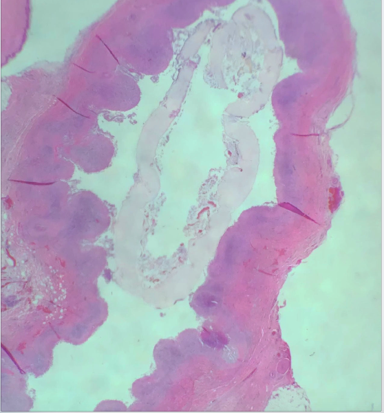 Corte histológico evidenciando lesão cística em partes moles com estrutura parasitária central compatível com Dermatobia hominis. A epiderme acima da lesão está íntegra (Hematoxilina & eosina, 100x)