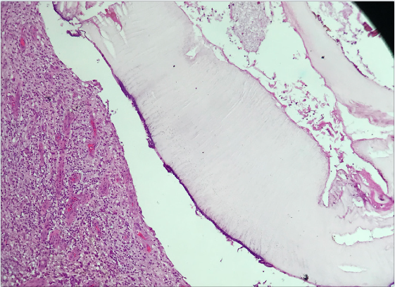 Lesão cística com intenso processo inflamatório crônico, reação gigantocelular tipo corpo estranho e tecido de granulação, além de neoformação vascular. Presença de parasita compatível com Dermatobia hominis (Hematoxilina & eosina; 400x)