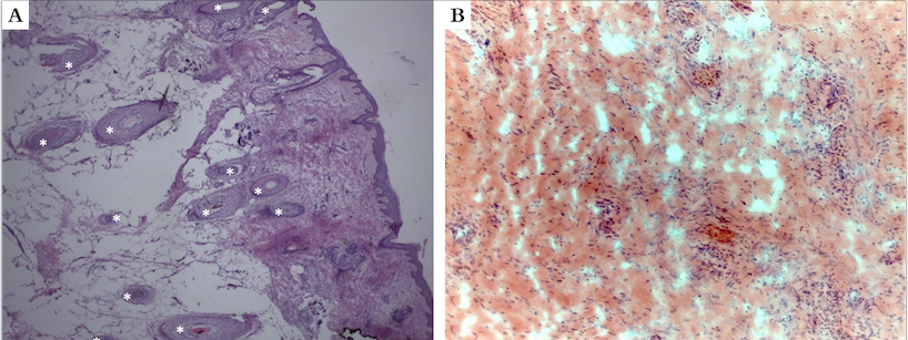 Couro cabeludo. a) Grande quantidade de folículos pilosos (asteriscos brancos), presentes inclusive na profundidade do tecido celular subcutâneo (corte vertical, Hematoxilina & eosina, 40x). b) Periósteo. Colágeno denso e presença de fibroblastos em grande quantidade (corte horizontal, Hematoxilina & eosina, 100x)