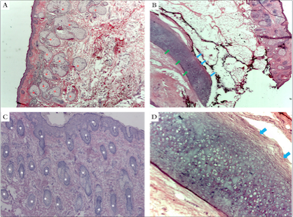 Pavilhão auricular. a) Hélice. Grande quantidade de glândulas sebáceas (asteriscos vermelhos) (corte horizontal, Hematoxilina & eosina, 40x). b) Corte de espessura total em hélice. Cartilagem da hélice (setas verdes) sob tecido celular subcutâneo. Pericôndrio aderido à cartilagem (setas azuis) (corte vertical, Hematoxilina & eosina, 25x). c) Histologia da concha auricular. Grande quantidade de folículos pilosos (asteriscos brancos) (corte vertical, Hematoxilina & eosina, 40x). d) Detalhe dos condrócitos e pericôndrio aderido à cartilagem (setas azuis) (corte vertical, Hematoxilina & eosina, 100x)