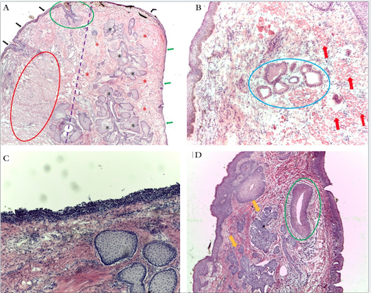 Histologia palpebral. a) Divisão da lamela anterior e posterior (linha tracejada violeta); fibras do músculo orbicular na lamela anterior (círculo vermelho); glândulas de Zeiss adjacente a folículo piloso de cílio (círculo verde); glândulas de Meibomiam (asteriscos pretos); tarso (asteriscos vermelhos); epitélio conjuntival (setas verdes); epiderme pré-tarsal (setas pretas) Pálpebra (corte transversal, Hematoxilina & eosina, 25x). b) Glândulas de Moll (círculo azul); músculo orbicular (setas vermelhas) (corte transversal, Hematoxilina & eosina, 40x). c) Detalhe do epitélio conjuntival (corte transversal, Hematoxilina & eosina, 40x). d) Margem comprometida por carcinoma basocelular nodular (setas amarelas), próxima ao canalículo lacrimal (círculo verde) (corte transversal, Hematoxilina & eosina, 25x