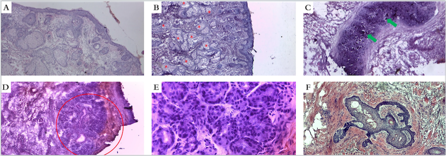 Nariz: a) Dorso nasal (corte horizontal, Hematoxilina & eosina, 40x). b) Asa nasal. Maior densidade de glândulas sebáceas (asteriscos vermelhos) (corte vertical, Hematoxilina & eosina, 40x). c) Cartilagem alar (detalhe) (setas verdes) (corte horizontal, Hematoxilina & eosina, 100x). d) Epitélio de revestimento mucoso nasal (setas pretas) com glândulas mucosas (círculo vermelho) (corte vertical, Hematoxilina & eosina, 25x). e) Em detalhe, glândulas mucosas nasais (corte vertical, Hematoxilina & eosina, 100x). f) Proliferação basaloide perifolicular (corte horizontal, Hematoxilina & eosina, 100x)