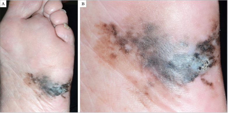Melanoma lentiginoso acral A) Mácula enegrecida com as características de: Assimetria, Bordas irregulares, Cores variadas, Diâmetro grande e E crescimento radial progressivo; B) Detalhe da mácula de limites imprecisos Iconografia ilustrativa: do arquivo fotográfico do Departamento de Dermatologia da UNESP - Botucatu