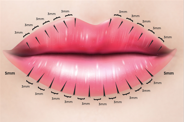 Injeções ao longo do lábio superior e inferior, a cada 2-3mm, desde a comissura oral em direção medial