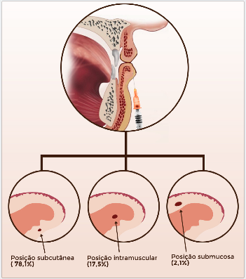 Posição das artérias labiais em relação ao músculo orbicular da boca, respectivamente: subcutânea(78,1%), intramuscular(17,5%), submucosa (2,1%)