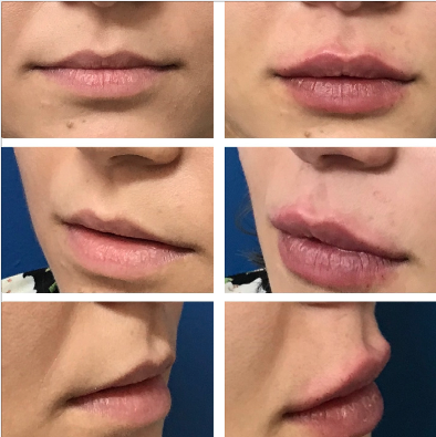 Fotos de antes e imediatamente após preenchimento labial com 1ml de ácido hialurônico. Vista frontal e lateral