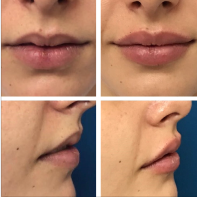 Fotos de antes e imediatamente após preenchimento labial com 1ml de ácido hialurônico. Vista frontal e lateral