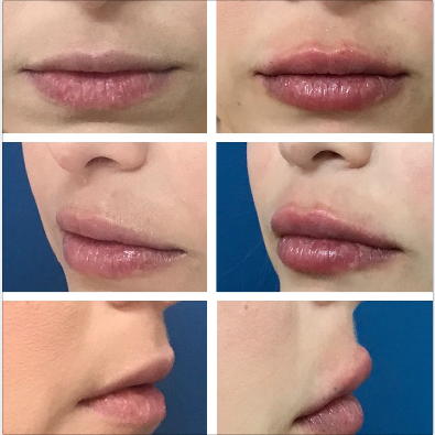 Fotos de antes e imediatamente após preenchimento labial com 1ml de ácido hialurônico. Vista frontal e lateral