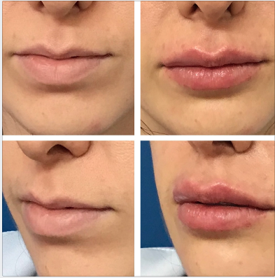 Fotos de antes e imediatamente após preenchimento labial com 1ml de ácido hialurônico. Vista frontal e lateral