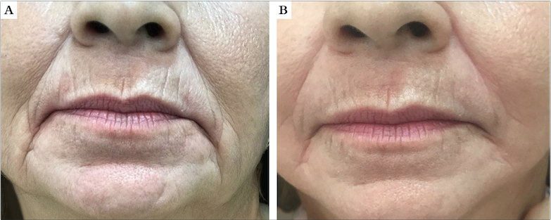 Paciente 1, feminina, 64 anos. A) Antes da aplicação do procedimento; B) 45 dias após a aplicação da 3ª sessão do laser de CO2 potencializado com a técnica de CROLL modificada