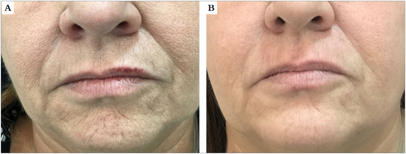 Paciente 2, feminina, 59 anos. A) Antes da aplicação do procedimento; B) 45 dias após a aplicação da 3ª sessão do laser de CO2 potencializado com a técnica de CROLL modificada