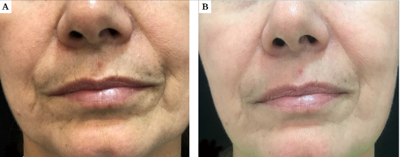 Paciente 3, feminina, 54 anos. A) Antes da aplicação do procedimento; B) 45 dias após a aplicação da 3ª sessão do laser de CO2 potencializado com a técnica de CROLL modificada