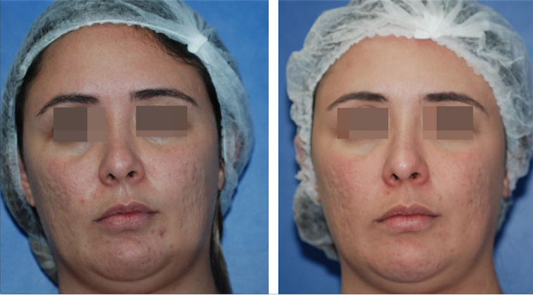 Paciente portadora de acne antes, e 90 dias ap&oacute;s o tratamento com Lactobacillus plantarum derma t&oacute;pico