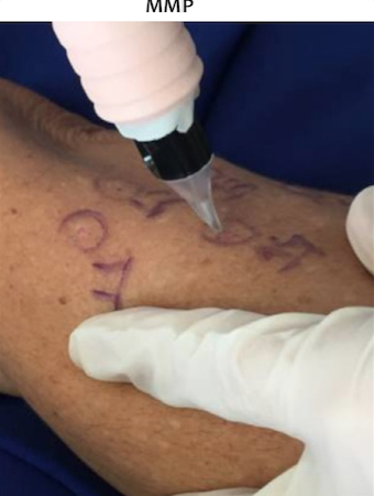 T&eacute;cnica de MMP, usando m&aacute;quina de tatuagem e agulha sete pontas, da periferia para o centro