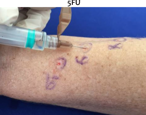 Aplica&ccedil;&atilde;o intrad&eacute;rmica de 5-FU usando agulha de insulina